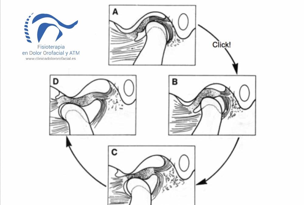 Desplazamiento anterior del disco. ¿Qué es? Enfoque anatómico y biomecánico. Causas y síntomas.