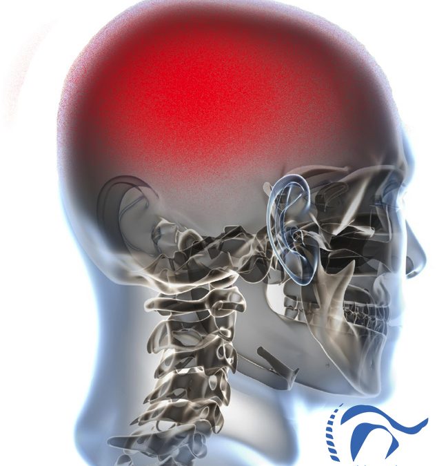 Migraña Crónica y Sí­ndrome de Dolor Regional Complejo