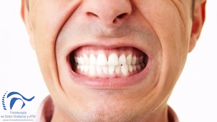 Bruxismo: apretar los dientes sin necesidad