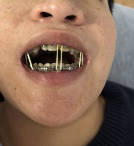 fijacion por gomas en cirugia maxilofacial