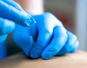 En conclusión, tanto el Botox para el dolor de cabeza como la punción seca son opciones válidas para el tratamiento de la cefalea tensional y las migrañas. Cada técnica tiene sus beneficios y posibles efectos secundarios, por lo que la elección dependerá del tipo de dolor y de las necesidades del paciente. Aunque el Botox no siempre es más efectivo que la punción seca, puede ser útil para quienes buscan una solución de largo plazo. La punción seca, en cambio, representa una alternativa menos invasiva con menos riesgos asociados. Al final, es el equipo médico especializado quien debe guiar al paciente hacia la mejor opción, teniendo en cuenta tanto la seguridad como la efectividad del tratamiento en cada caso particular. 